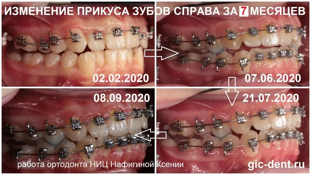 Фотоколлаж зубов справа. Динамика исправления прикуса за 5 месяцев. Исправление прикуса на брекетах h4. Лечащий ортодонт Нафигина Ксения.